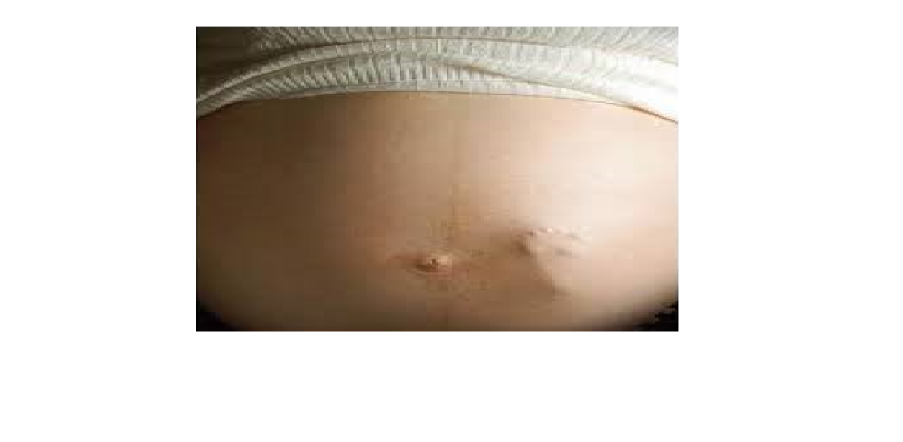 Pyridium for bladder spasms youtube